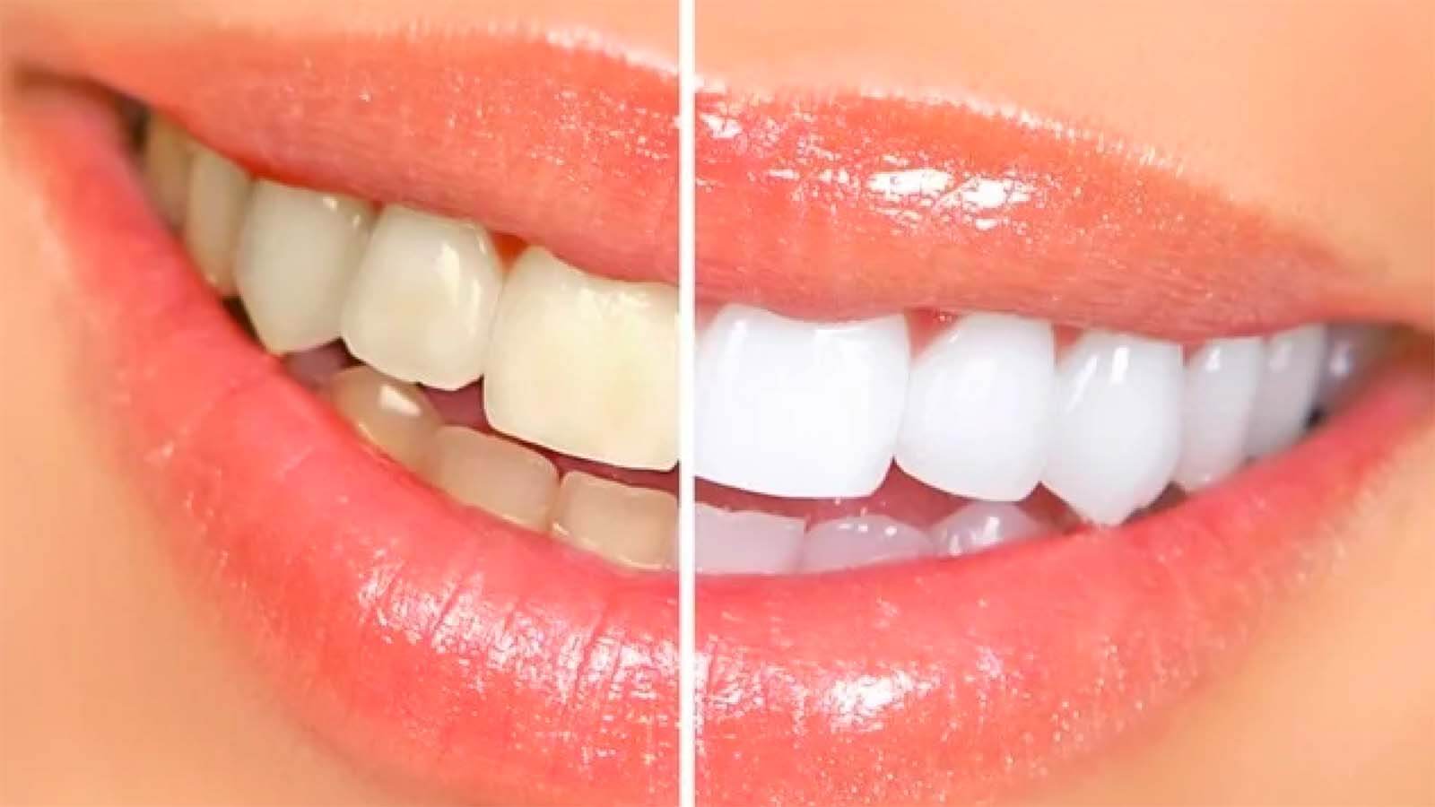 before and after smile makeover  Smile Makeover: Dental Treatment